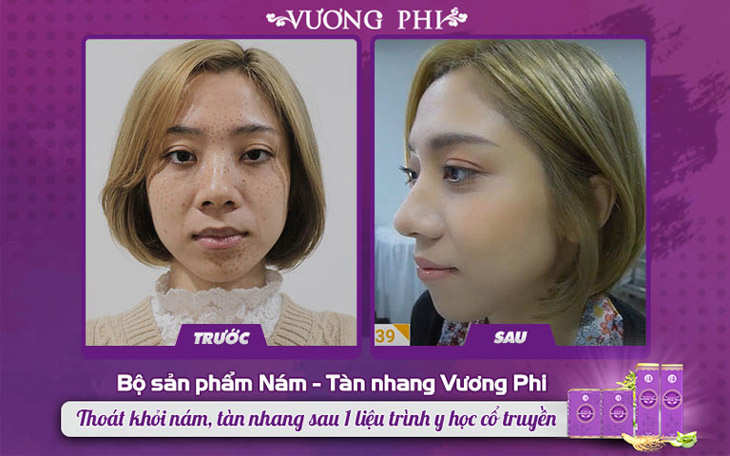 Làn da của khách hàng Hoài An trước và sau khi dùng BSP Nám Tàn nhang Vương Phi